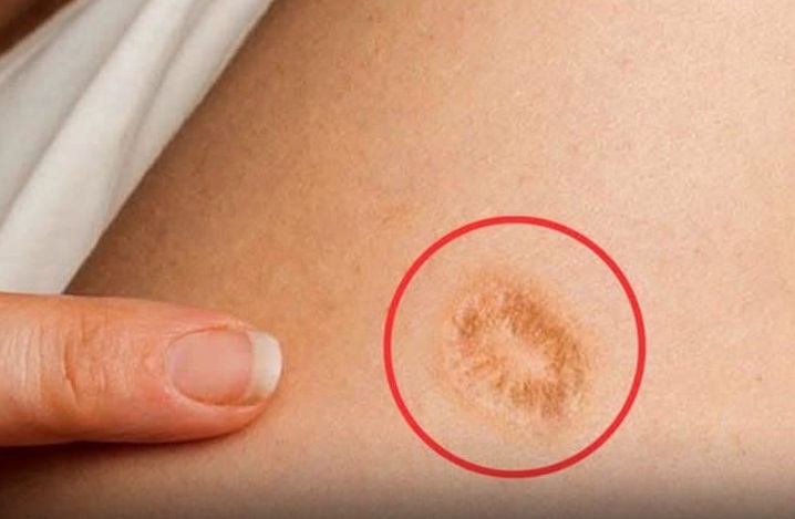 Você tem uma marca redonda no braço? Descubra o que ela significa