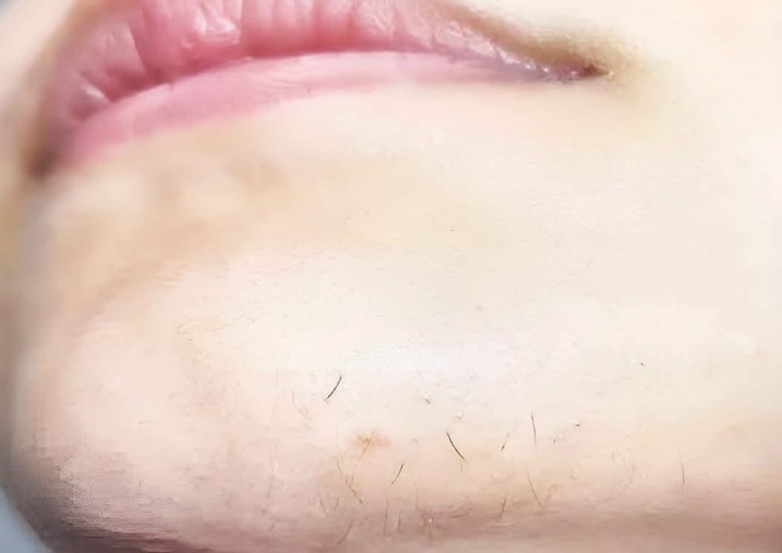 Pelos no queixo