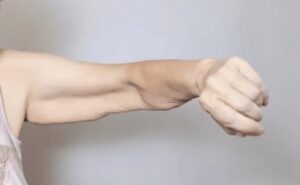 Sarcopenia