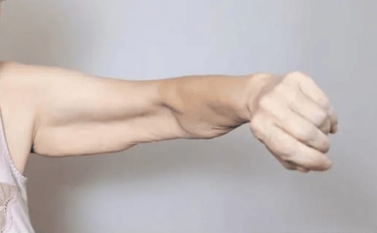 Sarcopenia