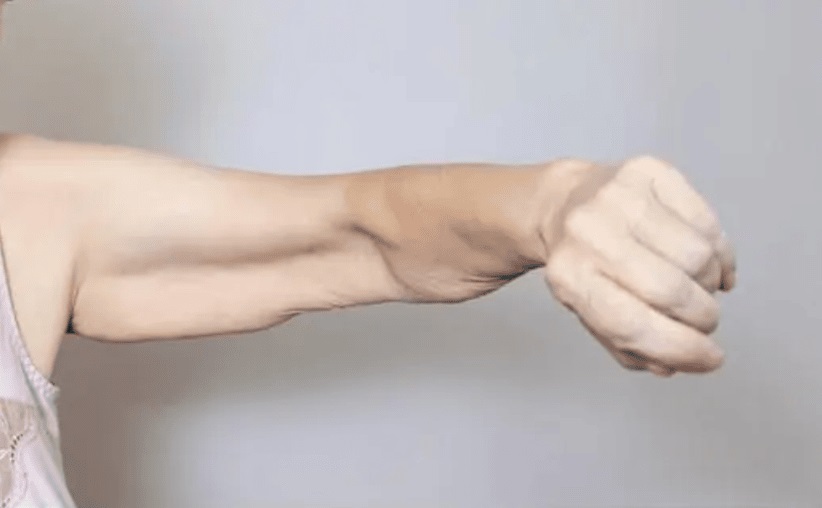 Sarcopenia