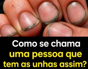 Como se chama uma pessoa que tem as unhas assim?
